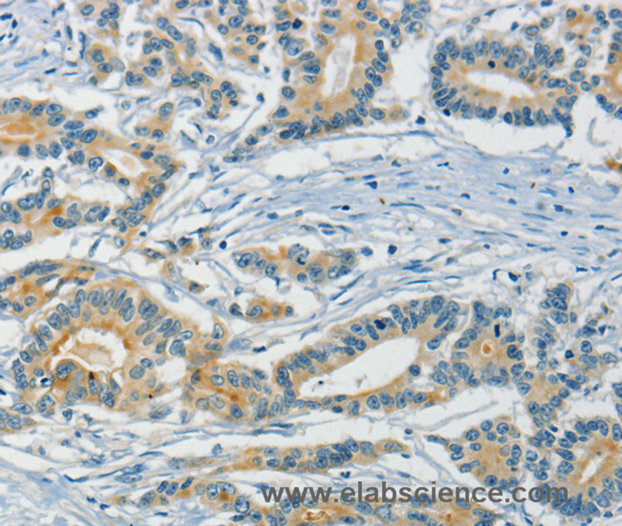 Immunohistochemistry of paraffin-embedded Human colon cancer using ASAH2 Polyclonal Antibody at dilution of 1:40