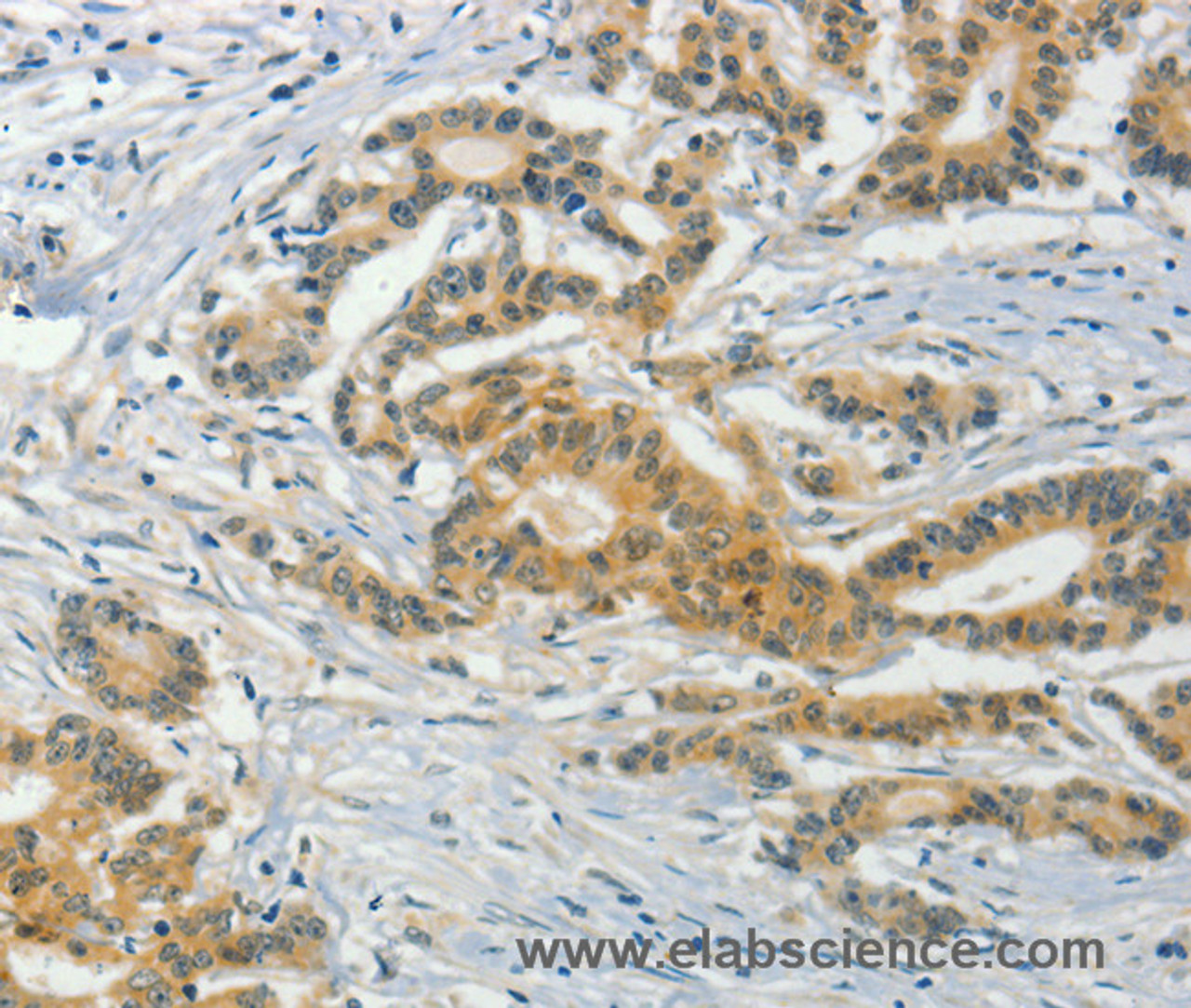 Immunohistochemistry of paraffin-embedded Human colon cancer tissue using ASB8 Polyclonal Antibody at dilution 1:50