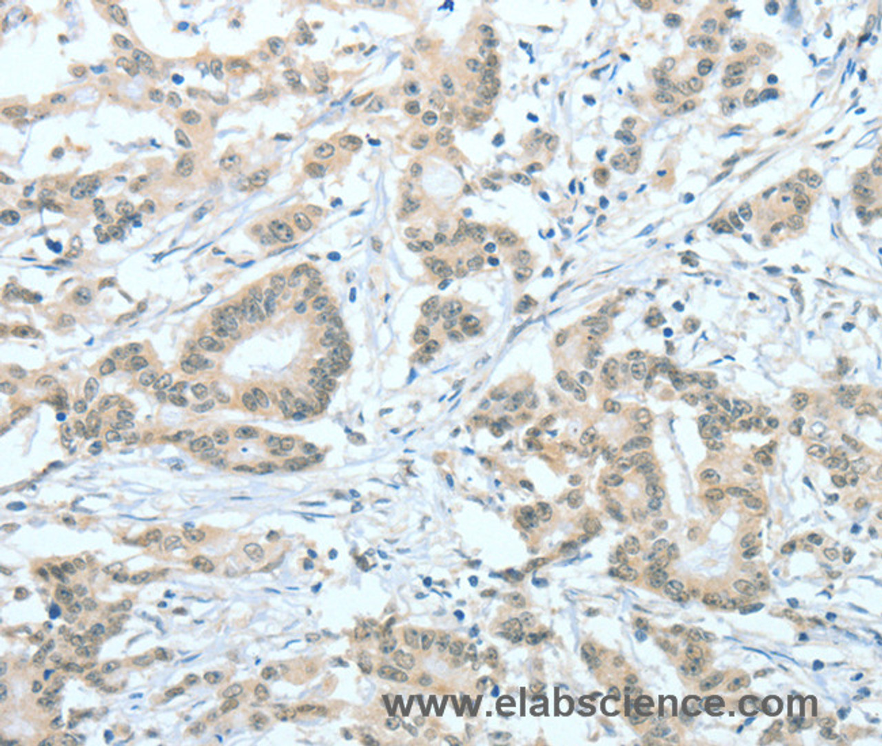Immunohistochemistry of paraffin-embedded Human colon cancer tissue using ASH2L Polyclonal Antibody at dilution 1:60