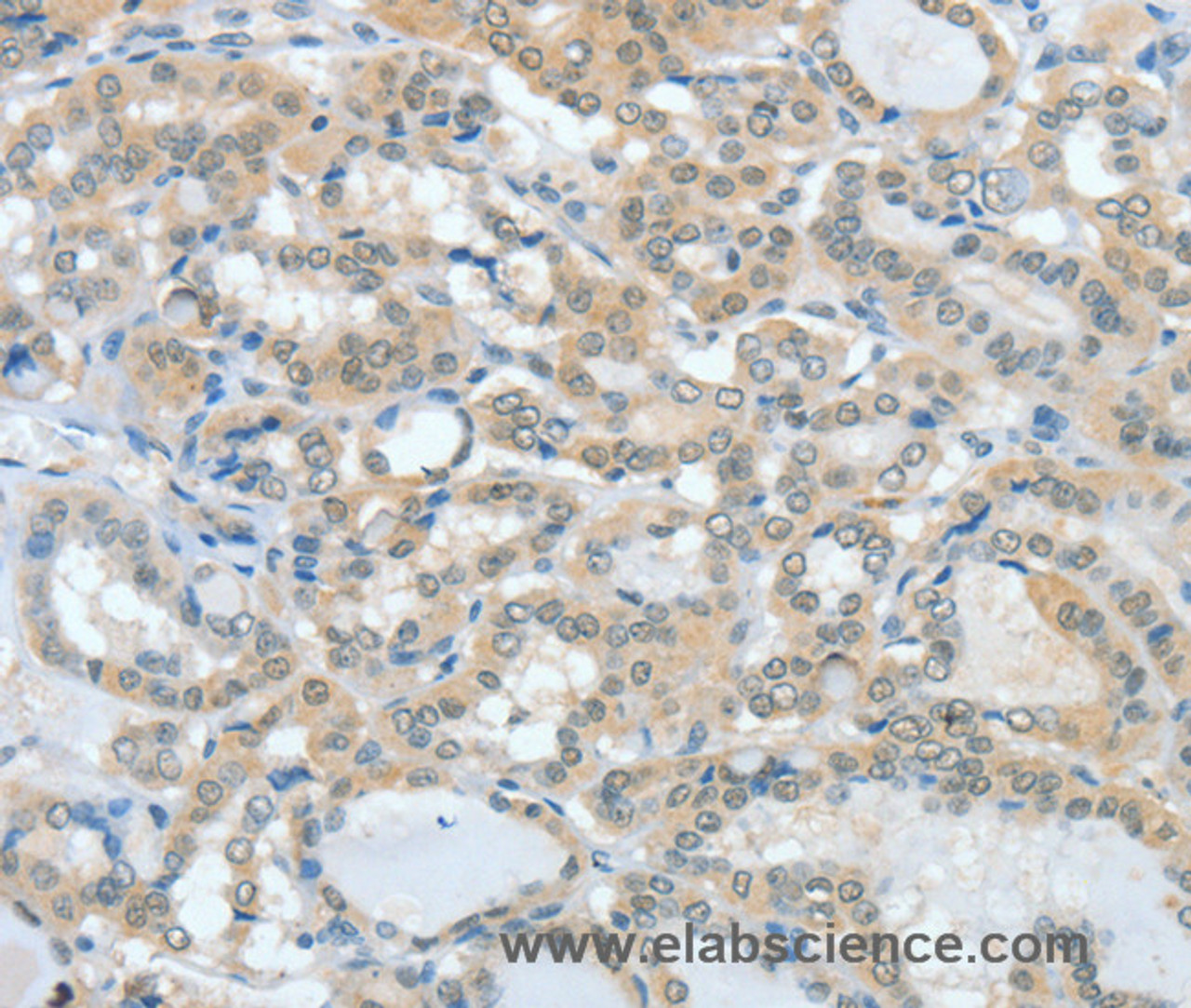 Immunohistochemistry of paraffin-embedded Human thyroid cancer tissue using ASH2L Polyclonal Antibody at dilution 1:60