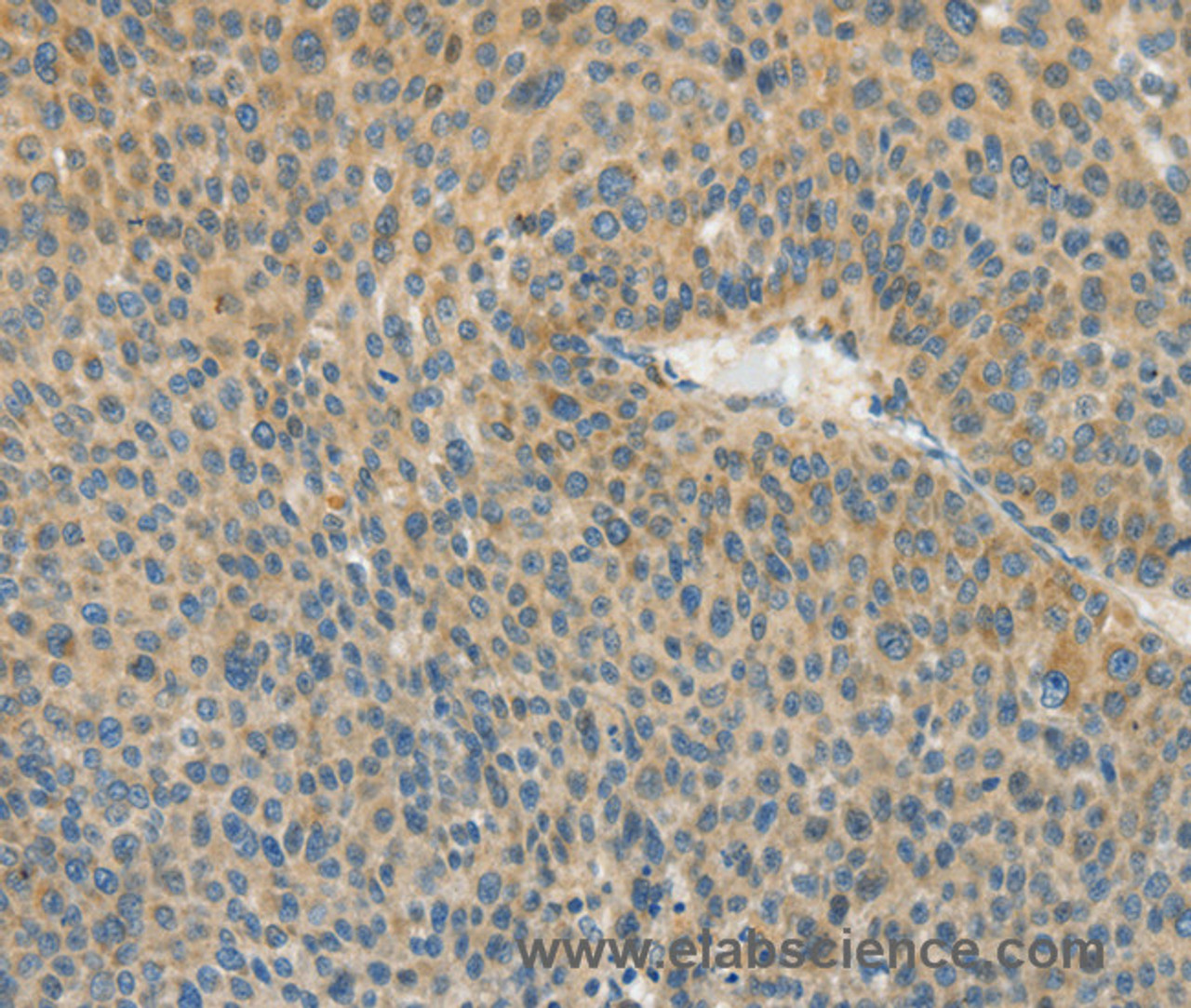 Immunohistochemistry of paraffin-embedded Human liver cancer using ASPA Polyclonal Antibody at dilution of 1:80