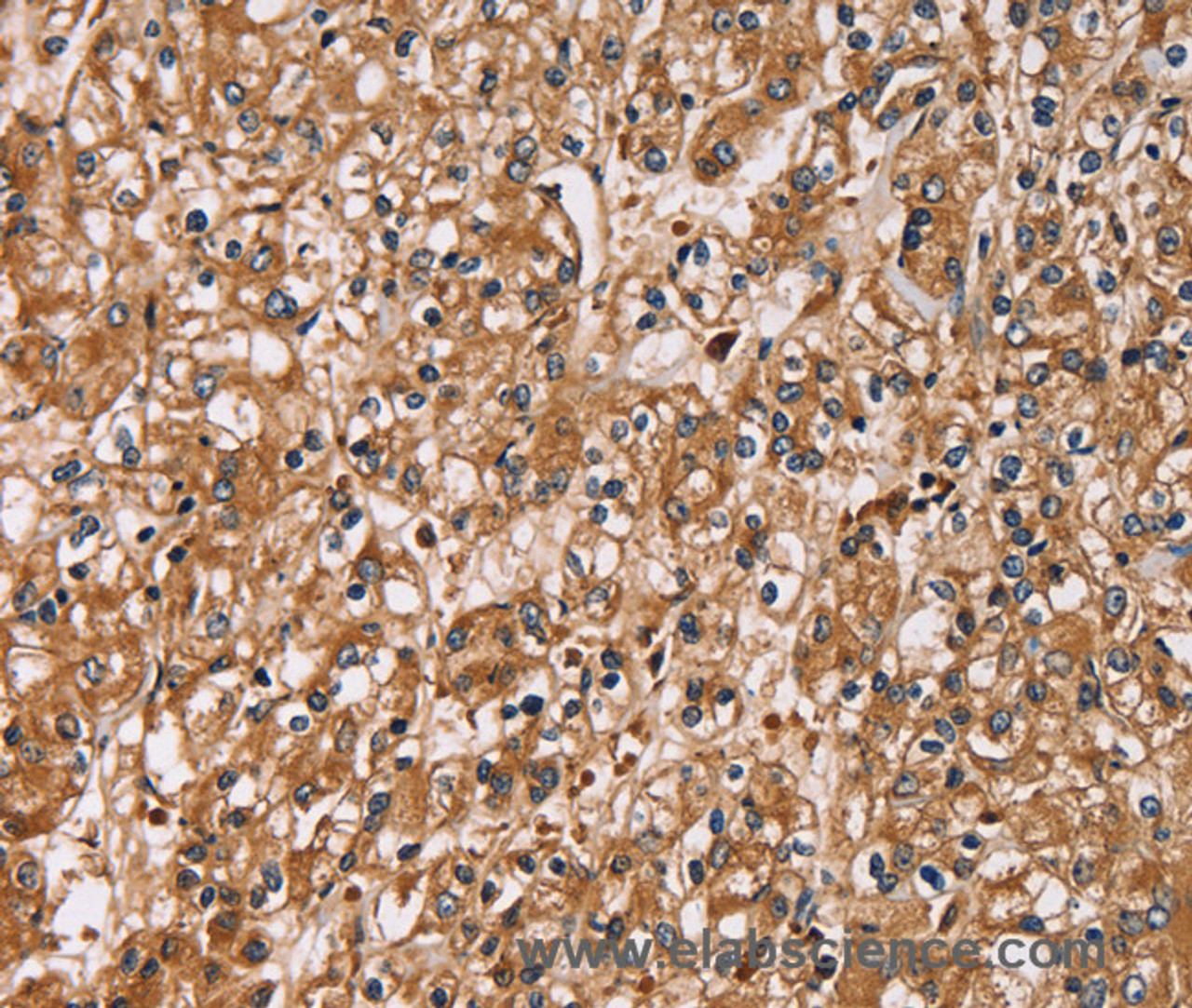 Immunohistochemistry of paraffin-embedded Human prostate cancer using HTR3C Polyclonal Antibody at dilution of 1:30