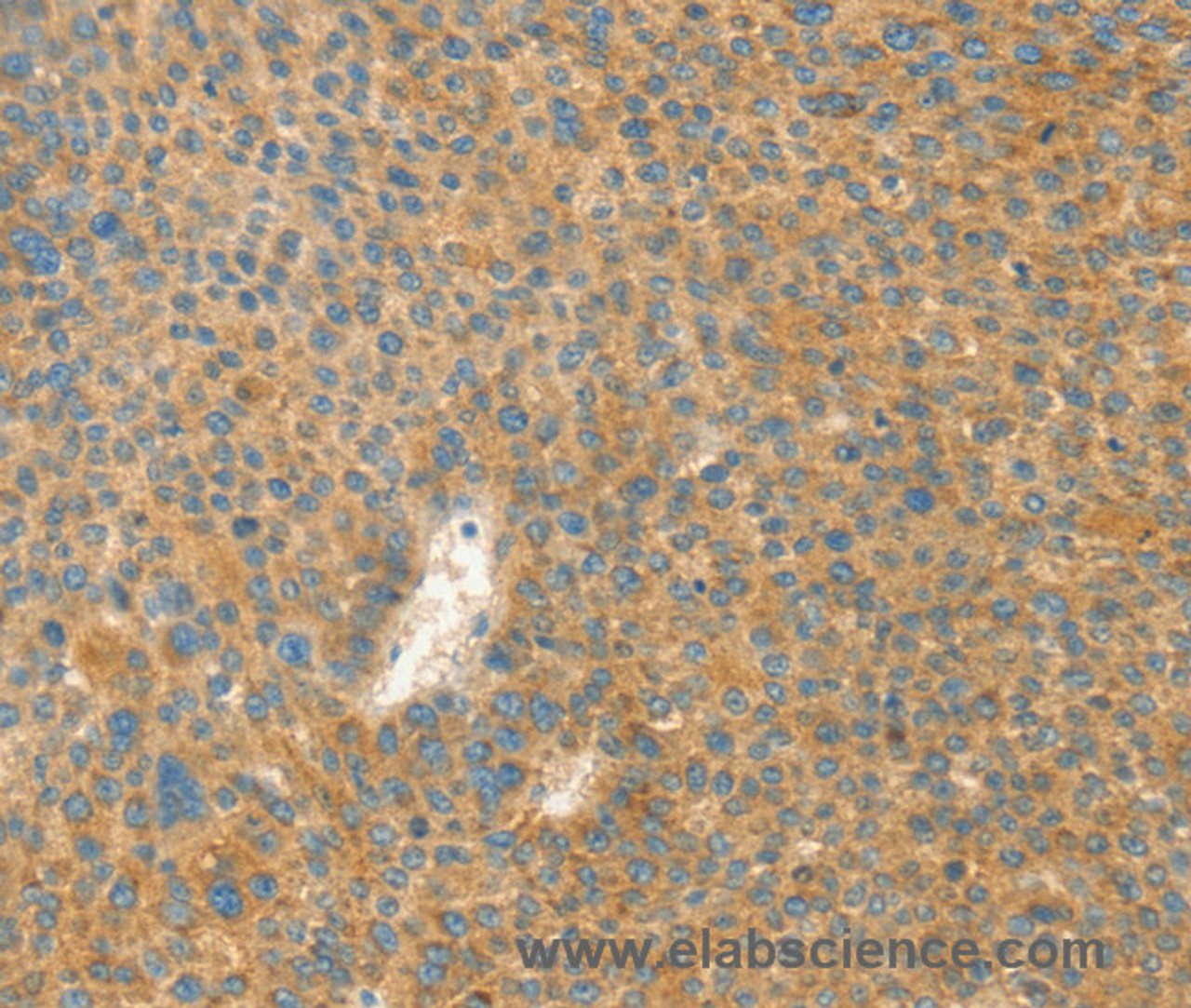 Immunohistochemistry of paraffin-embedded Human liver cancer tissue using AANAT Polyclonal Antibody at dilution 1:40