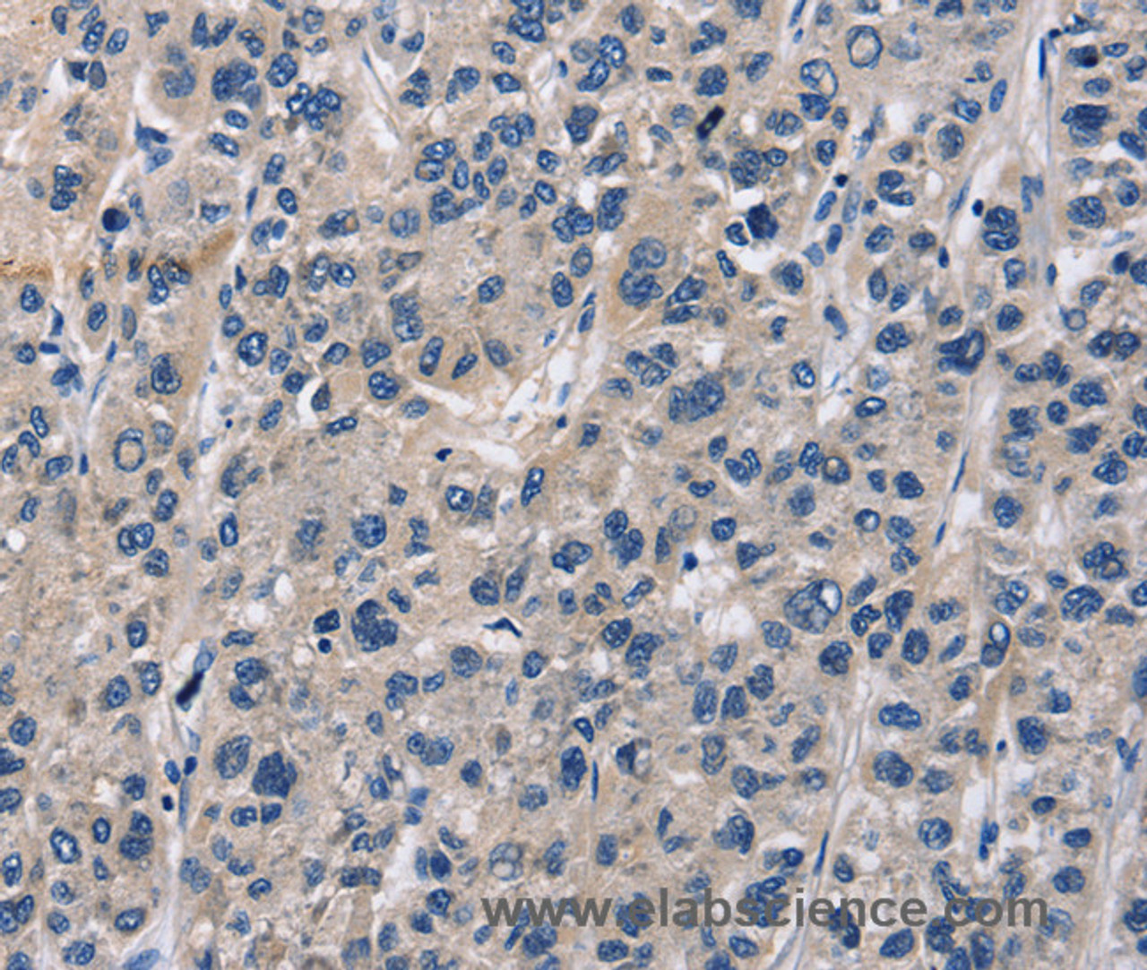 Immunohistochemistry of paraffin-embedded Human liver cancer tissue using ABI3BP Polyclonal Antibody at dilution 1:60