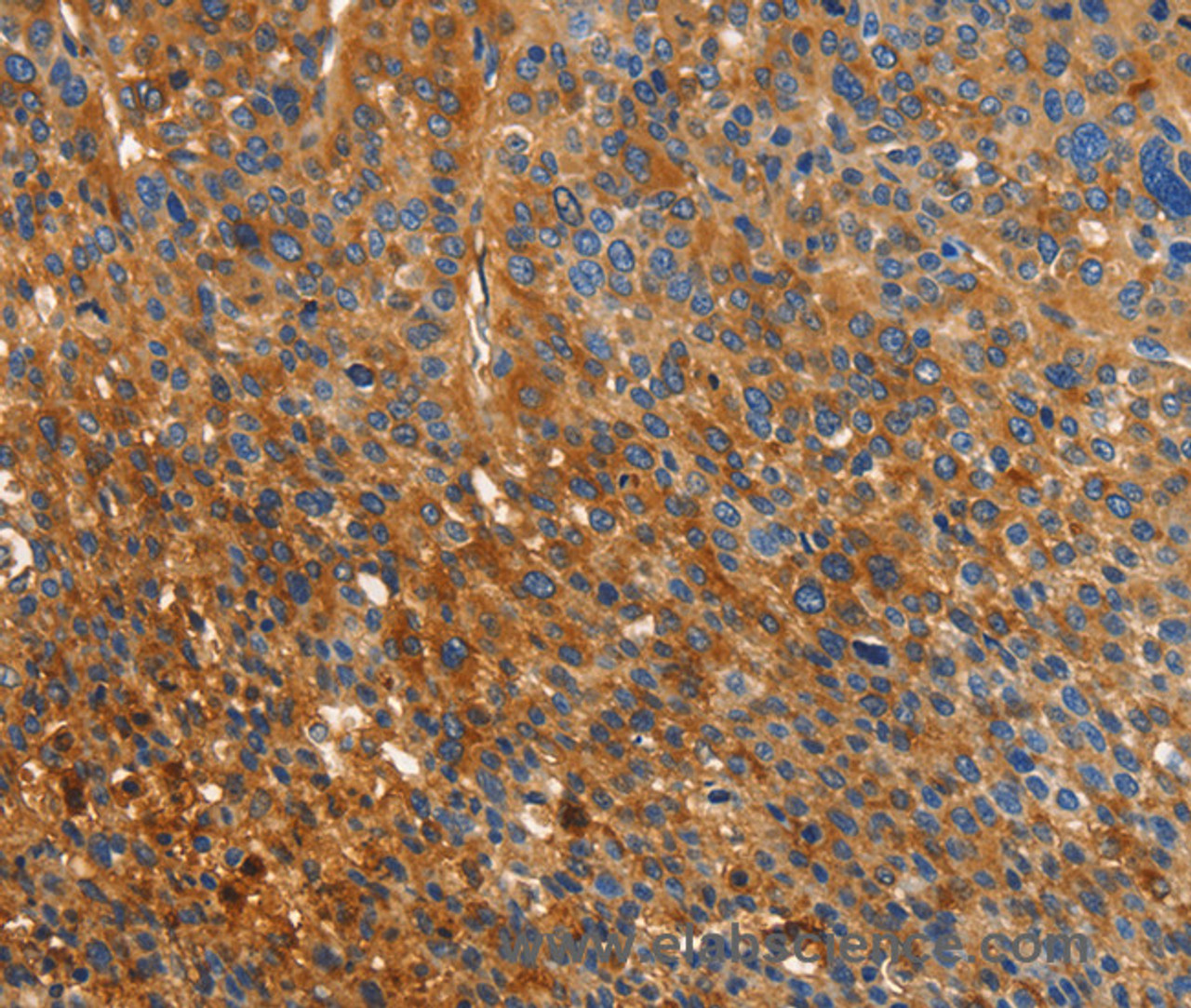 Immunohistochemistry of paraffin-embedded Human liver cancer using ORM2 Polyclonal Antibody at dilution of 1:40