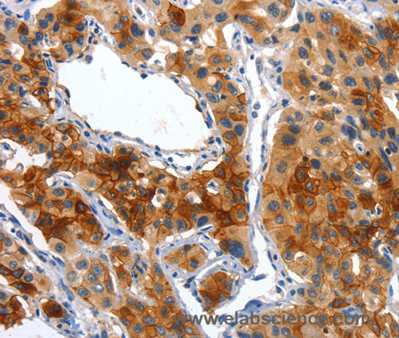 Immunohistochemistry of paraffin-embedded Human lung cancer using Placental Alkaline Phosphatase Polyclonal Antibody at dilution of 1:50