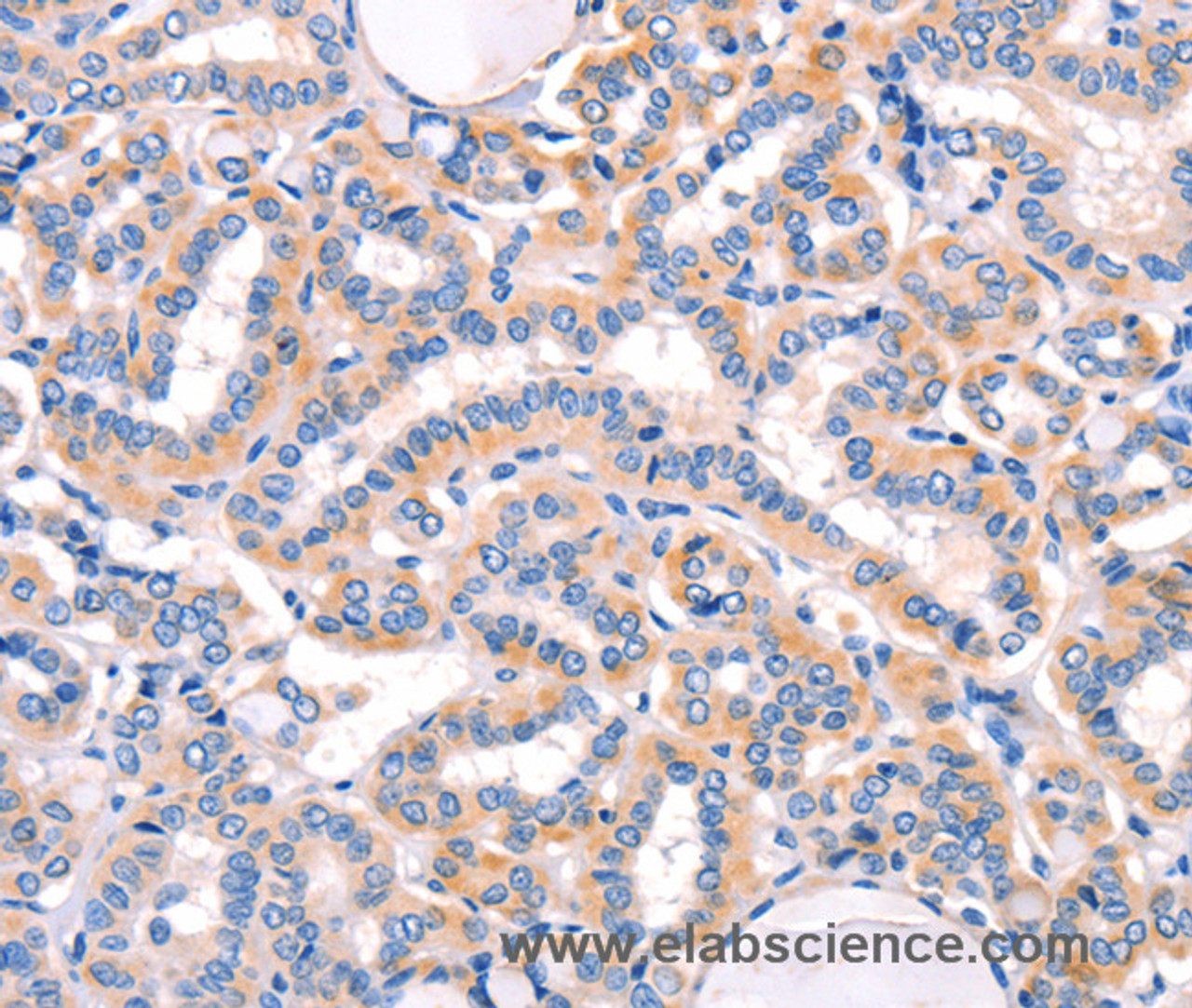 Immunohistochemistry of paraffin-embedded Human thyroid cancer using AMY2A Polyclonal Antibody at dilution of 1:50