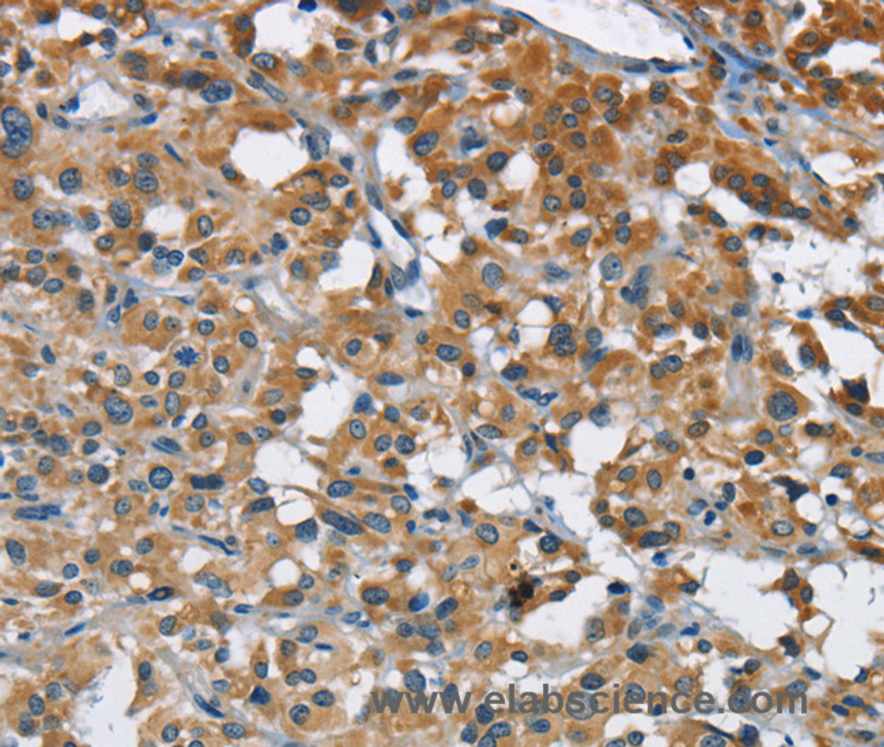 Immunohistochemistry of paraffin-embedded Human thyroid cancer tissue using ANKHD1 Polyclonal Antibody at dilution 1:40