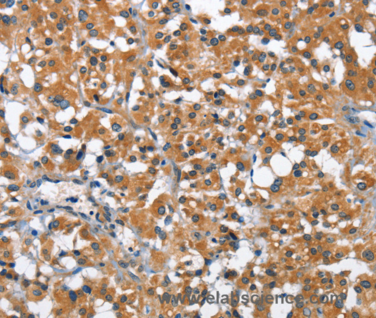 Immunohistochemistry of paraffin-embedded Human thyroid cancer using ARMCX2 Polyclonal Antibody at dilution of 1:40