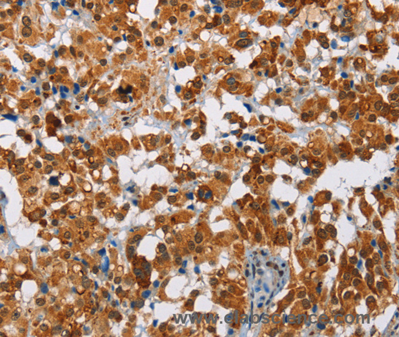 Immunohistochemistry of paraffin-embedded Human thyroid cancer tissue using ATXN1 Polyclonal Antibody at dilution 1:40