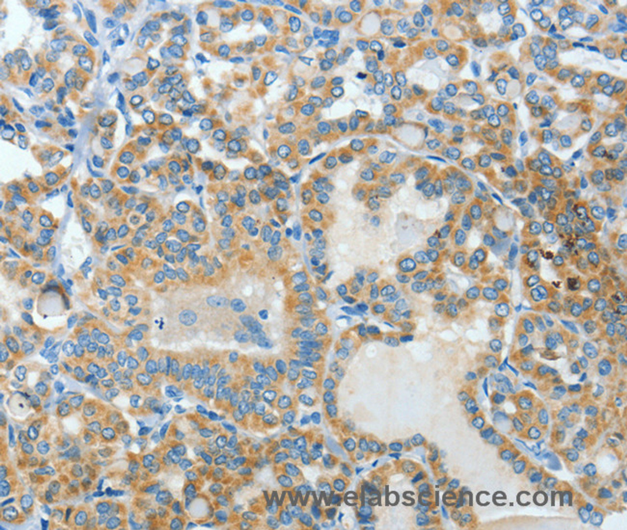 Immunohistochemistry of paraffin-embedded Human thyroid cancer using BAAT Polyclonal Antibody at dilution of 1:30