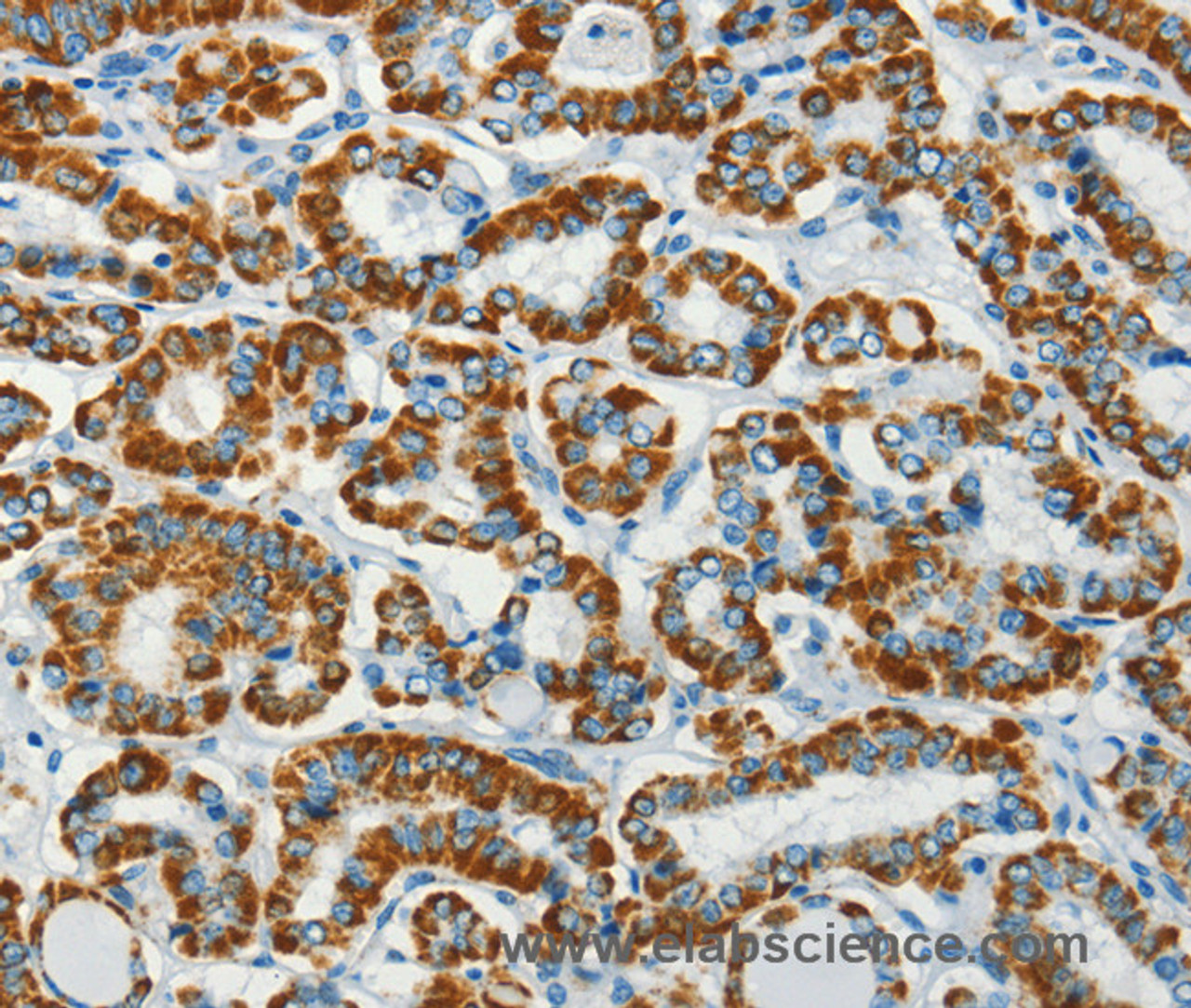 Immunohistochemistry of paraffin-embedded Human thyroid cancer using BCAT2 Polyclonal Antibody at dilution of 1:70