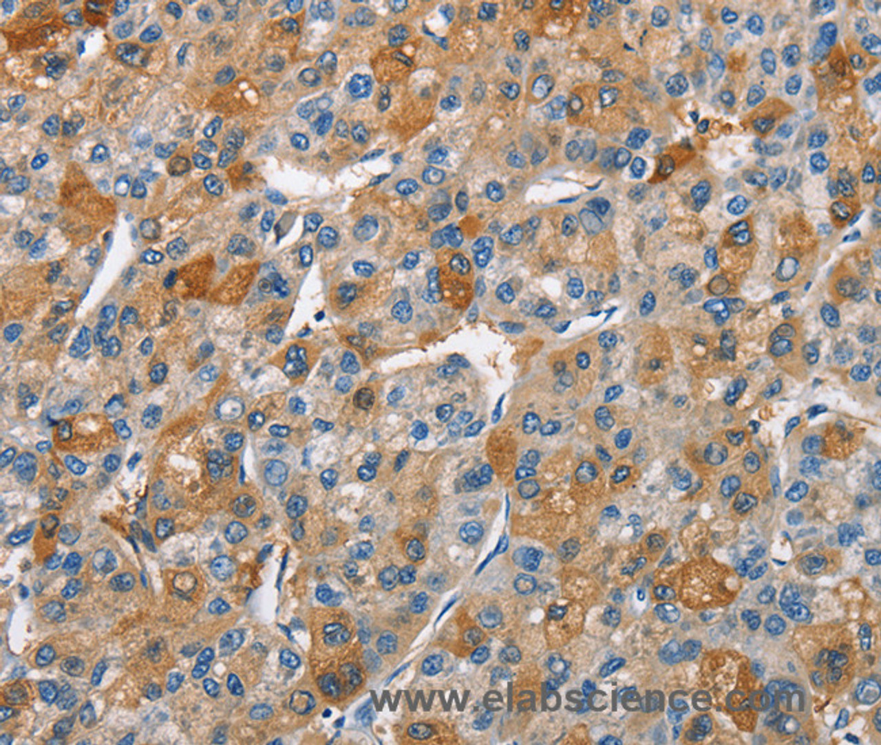 Immunohistochemistry of paraffin-embedded Human liver cancer using BCL10 Polyclonal Antibody at dilution of 1:40