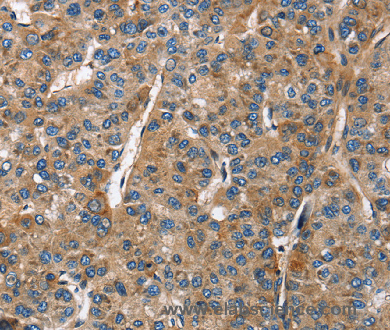 Immunohistochemistry of paraffin-embedded Human liver cancer tissue using BGN Polyclonal Antibody at dilution 1:50