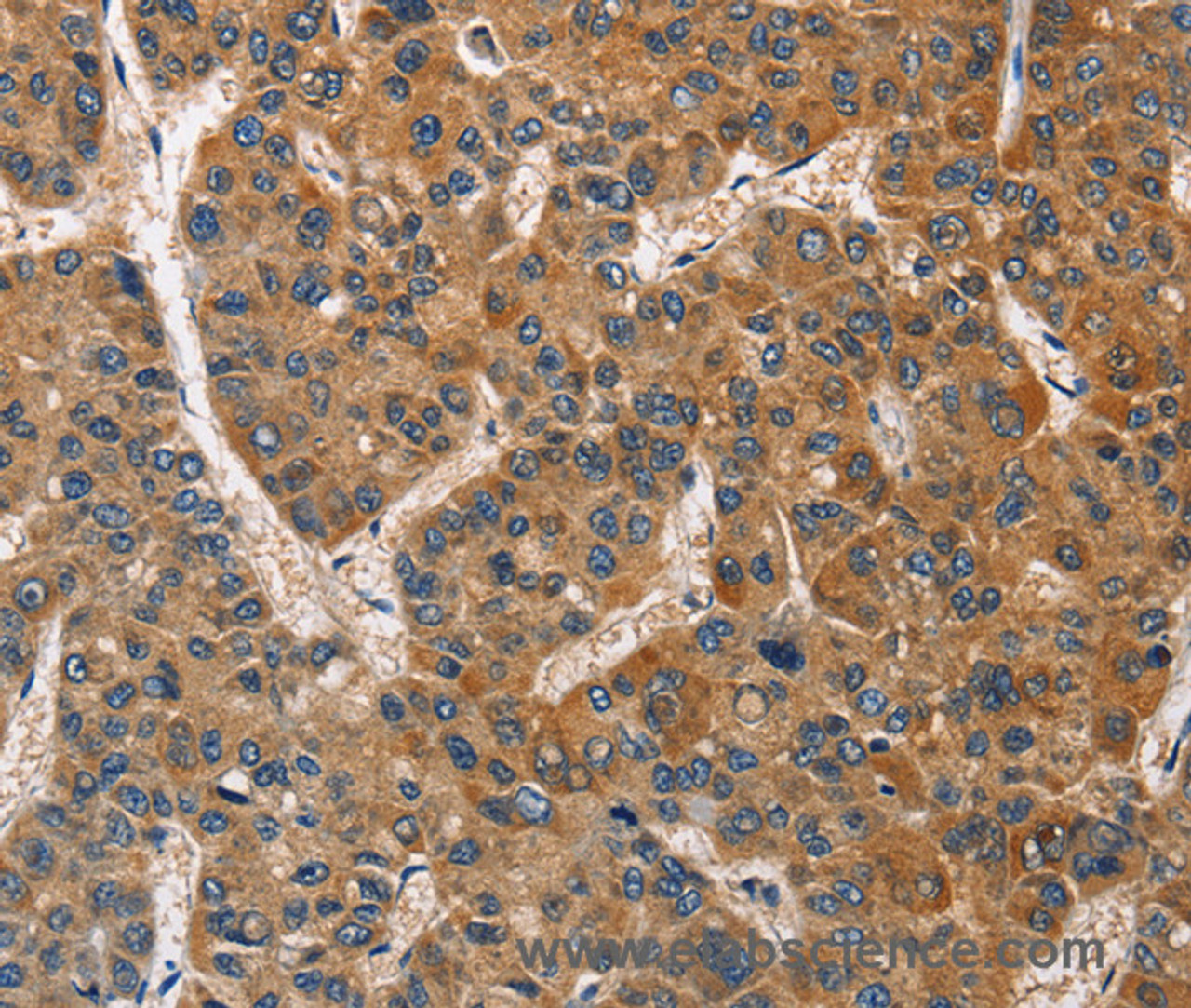 Immunohistochemistry of paraffin-embedded Human liver cancer using BABAM2 Polyclonal Antibody at dilution of 1:40
