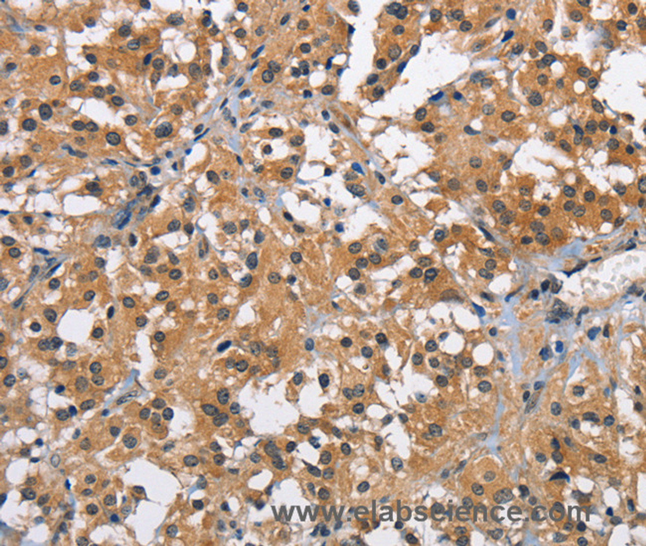 Immunohistochemistry of paraffin-embedded Human thyroid cancer using BABAM2 Polyclonal Antibody at dilution of 1:40