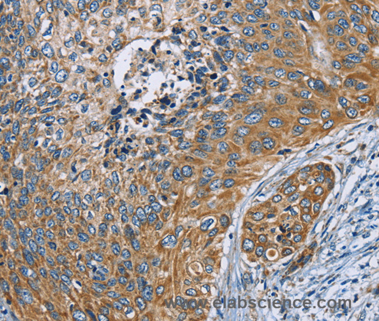 Immunohistochemistry of paraffin-embedded Human cervical cancer tissue using ZMYND11 Polyclonal Antibody at dilution 1:70