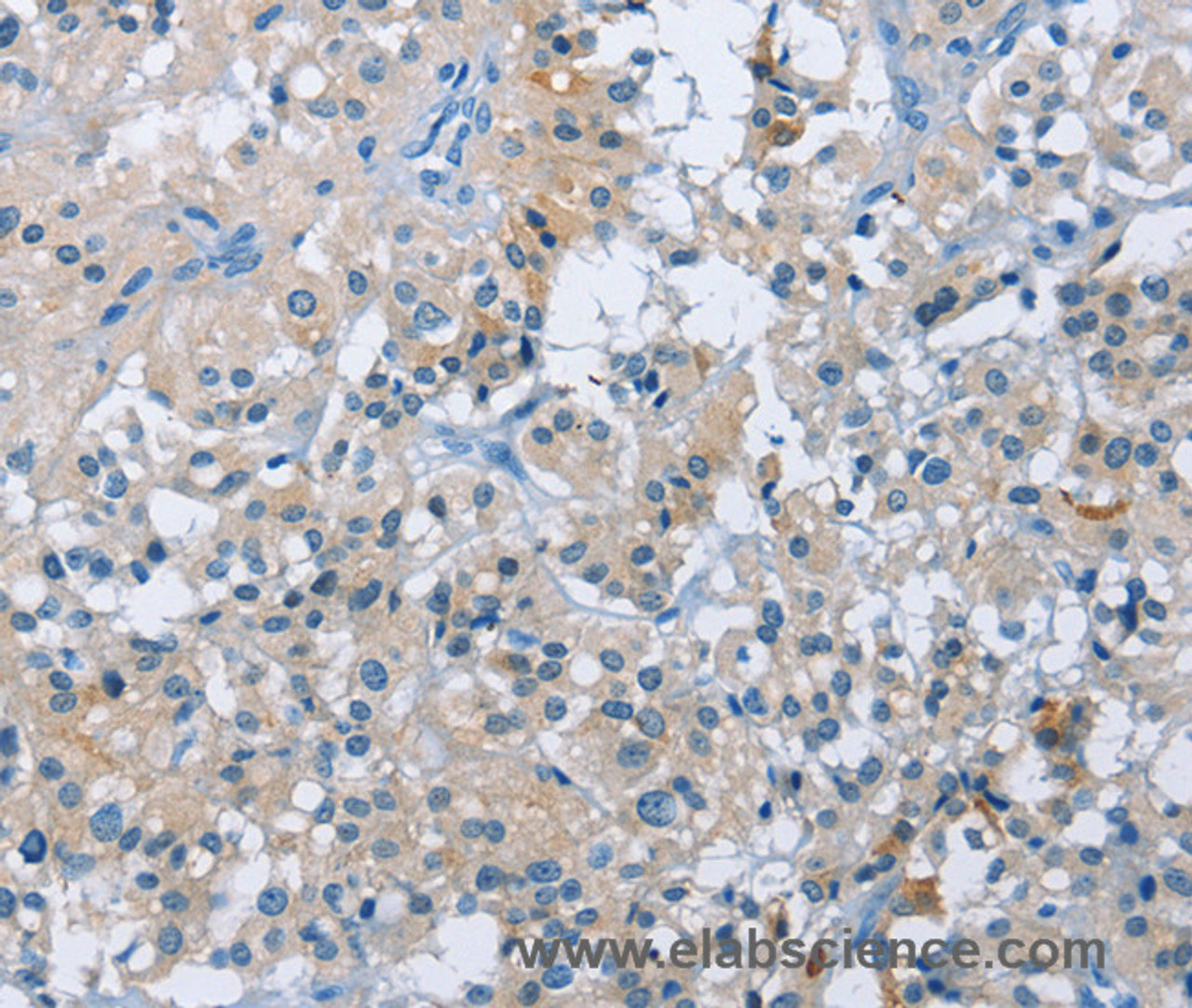 Immunohistochemistry of paraffin-embedded Human thyroid cancer tissue using BTN2A2 Polyclonal Antibody at dilution 1:50