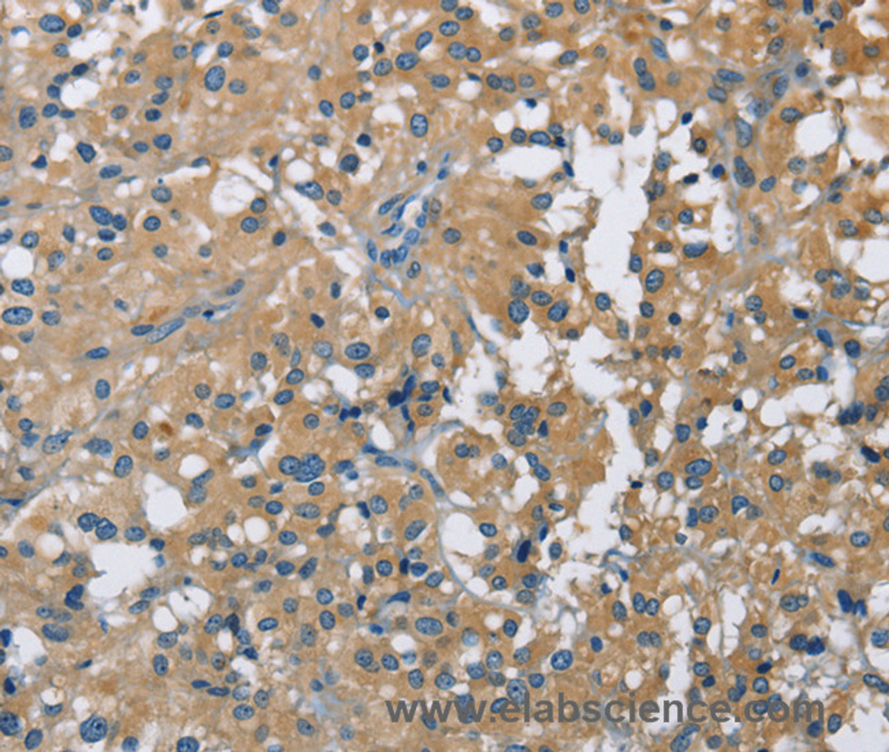 Immunohistochemistry of paraffin-embedded Human thyroid cancer using CAB39L Polyclonal Antibody at dilution of 1:40