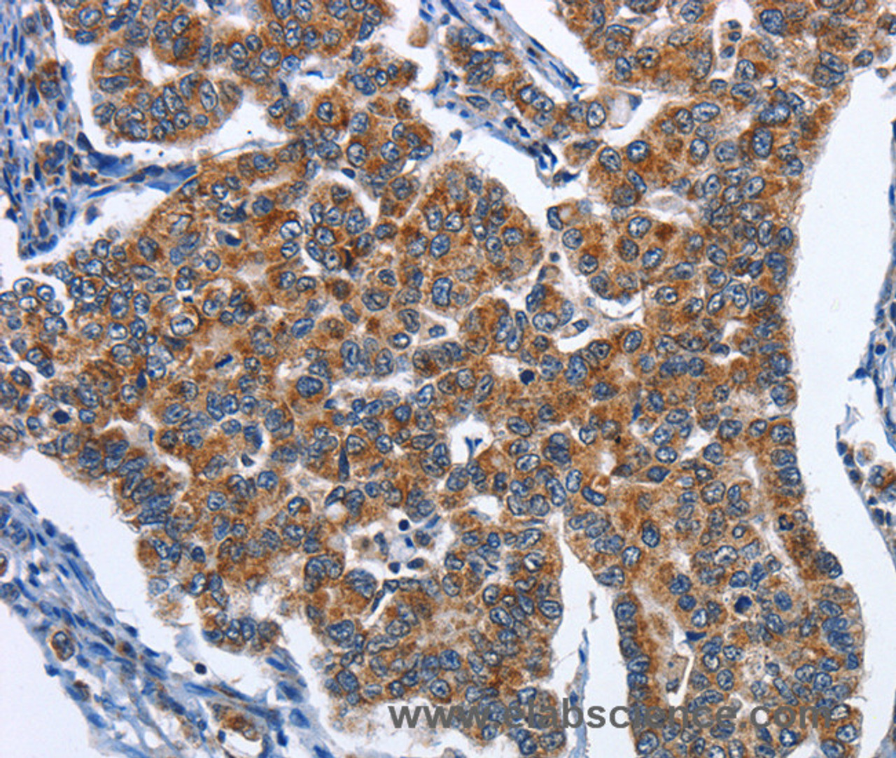 Immunohistochemistry of paraffin-embedded Human breast cancer tissue using CADM3 Polyclonal Antibody at dilution 1:40