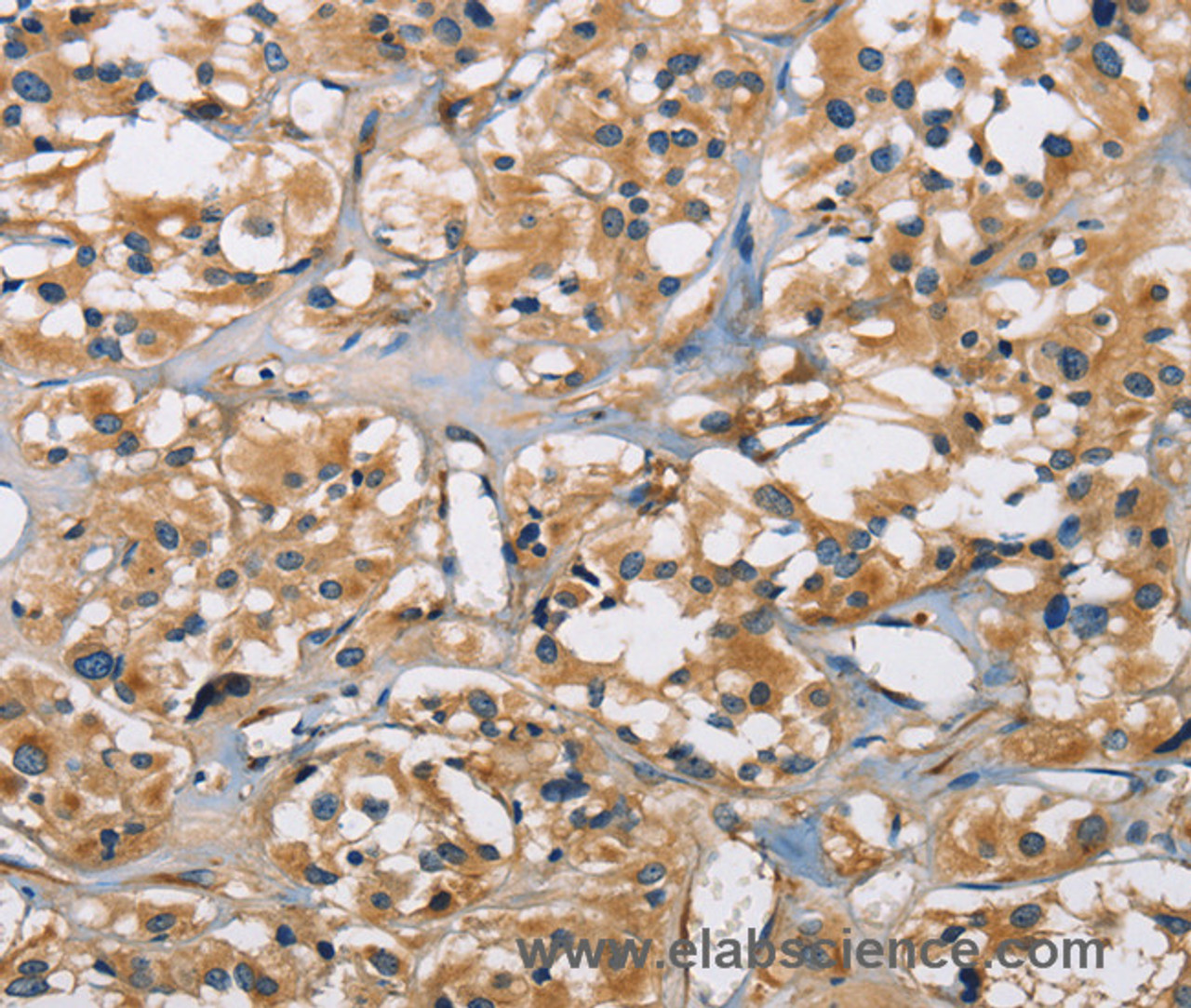 Immunohistochemistry of paraffin-embedded Human thyroid cancer using PPP3CA Polyclonal Antibody at dilution of 1:30