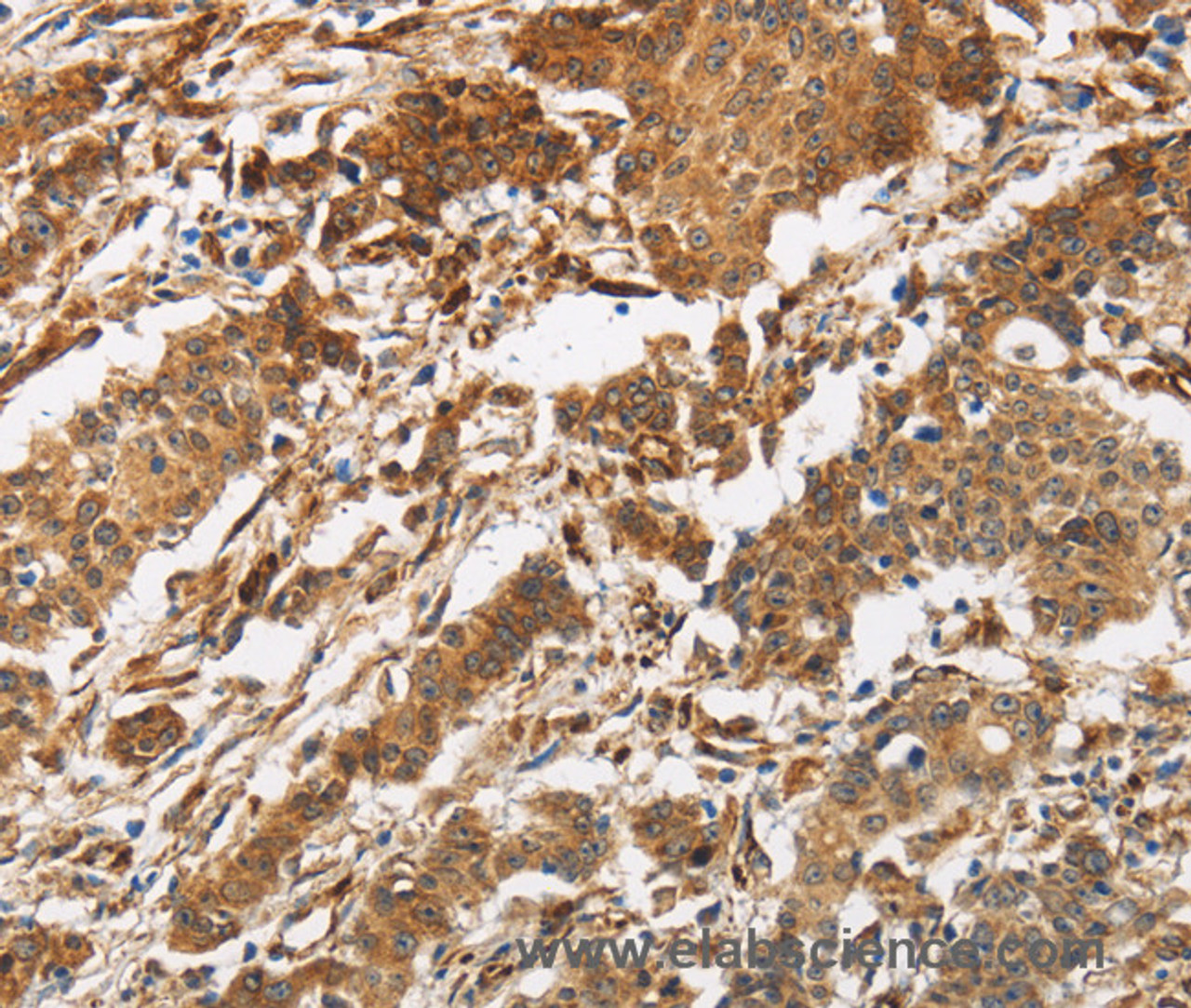 Immunohistochemistry of paraffin-embedded Human gasrtic cancer tissue using CALU Polyclonal Antibody at dilution 1:40