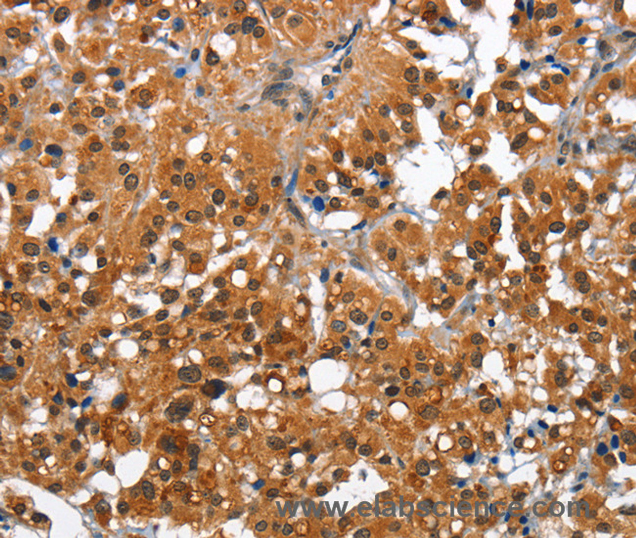 Immunohistochemistry of paraffin-embedded Human thyroid cancer tissue using CAMK1D Polyclonal Antibody at dilution 1:50