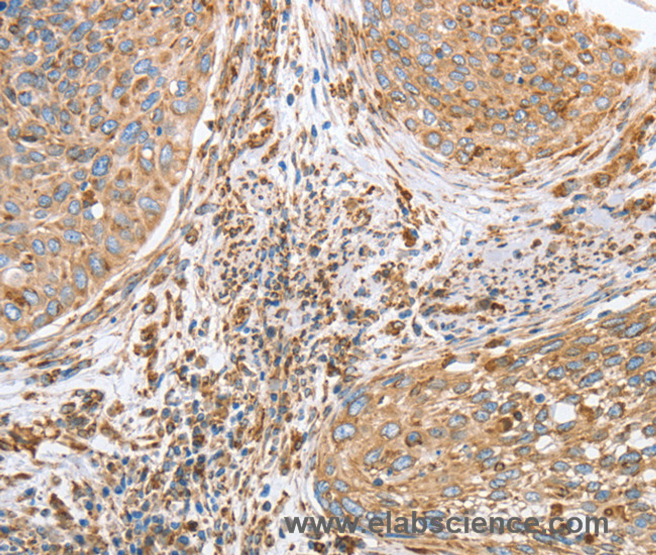 Immunohistochemistry of paraffin-embedded Human cervical cancer using CANX Polyclonal Antibody at dilution of 1:40