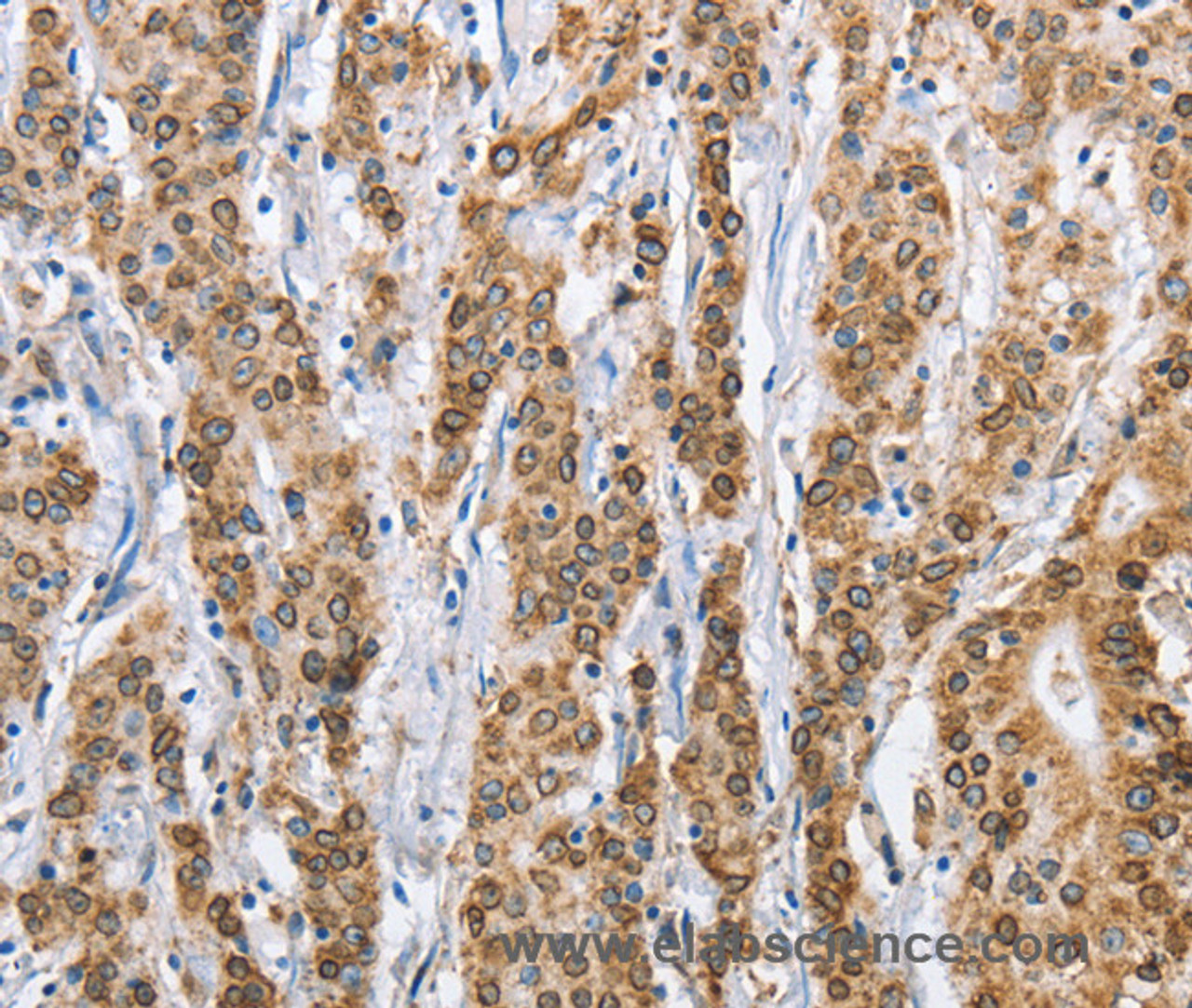 Immunohistochemistry of paraffin-embedded Human gastric cancer using CANX Polyclonal Antibody at dilution of 1:40
