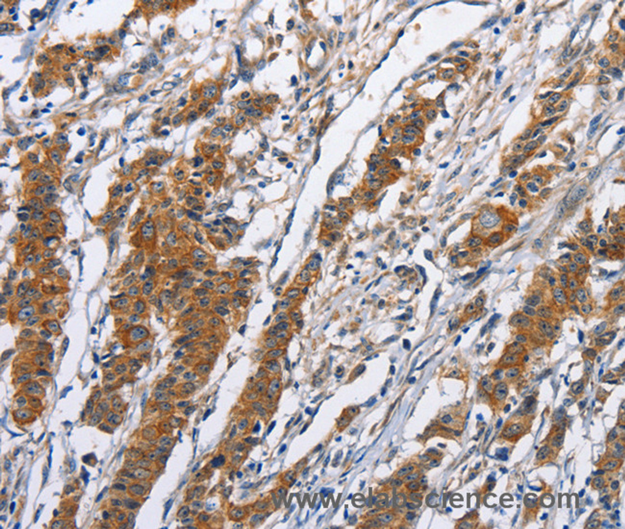 Immunohistochemistry of paraffin-embedded Human gasrtic cancer tissue using NCAPD3 Polyclonal Antibody at dilution 1:50