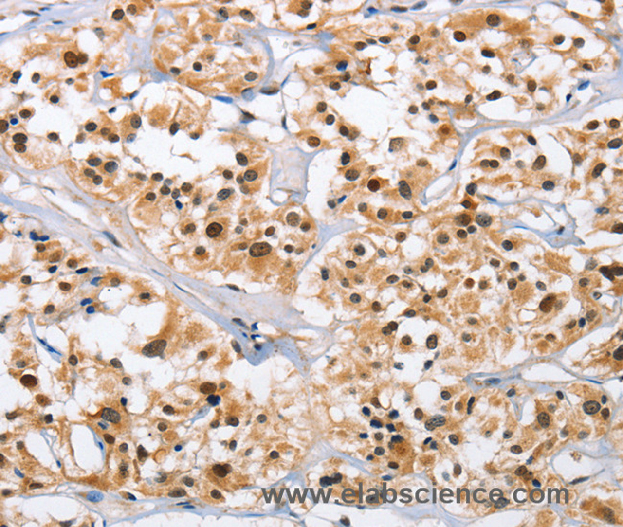 Immunohistochemistry of paraffin-embedded Human thyroid cancer tissue using NCAPD3 Polyclonal Antibody at dilution 1:50