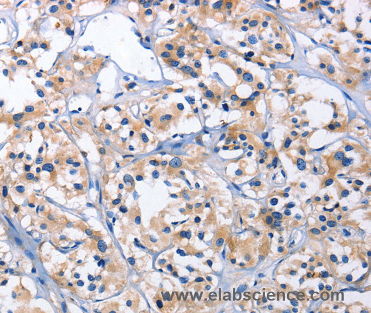 Immunohistochemistry of paraffin-embedded Human thyroid cancer using CAPZA2 Polyclonal Antibody at dilution of 1:30