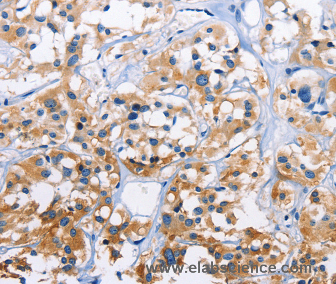 Immunohistochemistry of paraffin-embedded Human thyroid cancer tissue using CAPZA3 Polyclonal Antibody at dilution 1:70