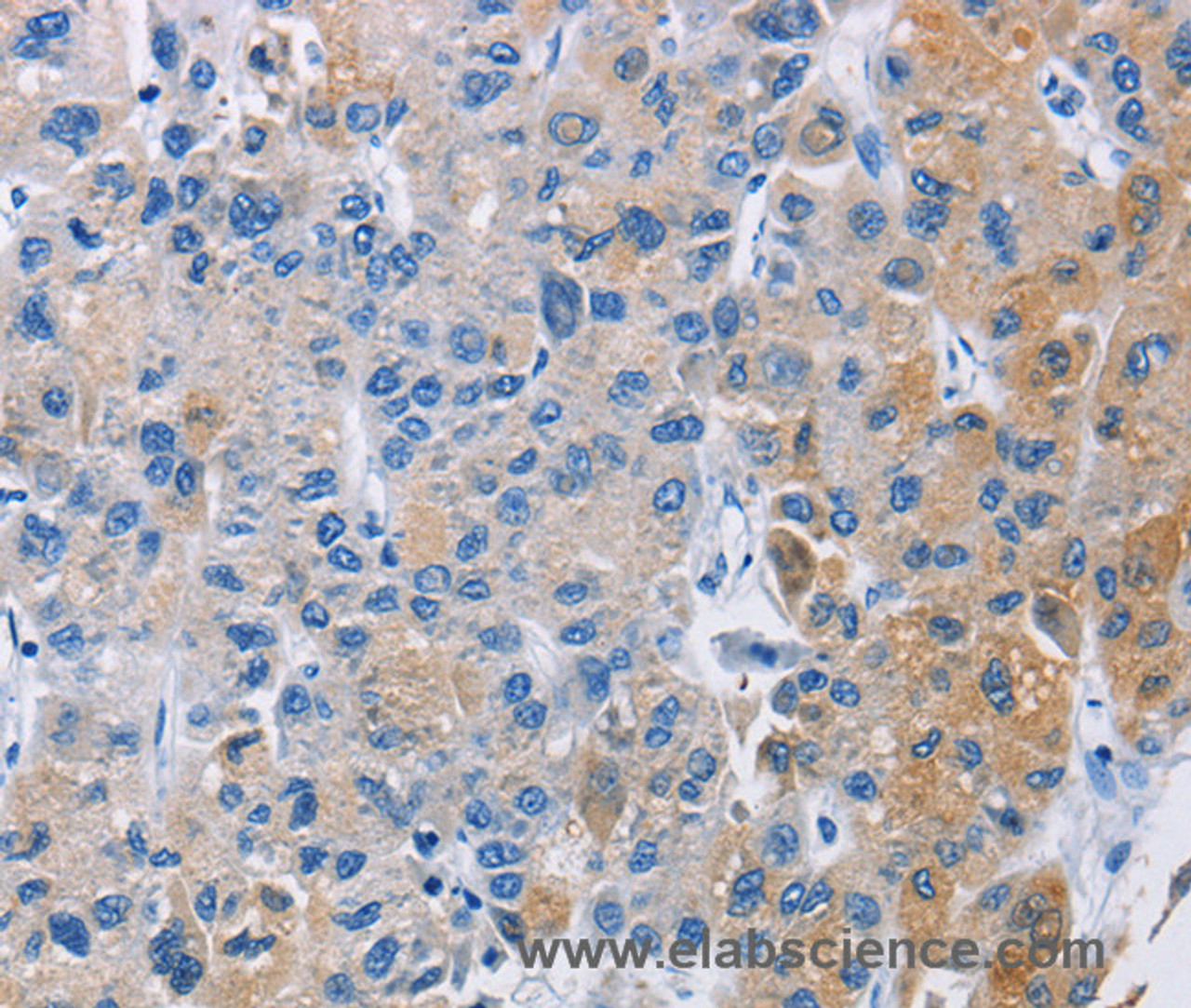 Immunohistochemistry of paraffin-embedded Human liver cancer using CARD14 Polyclonal Antibody at dilution of 1:30