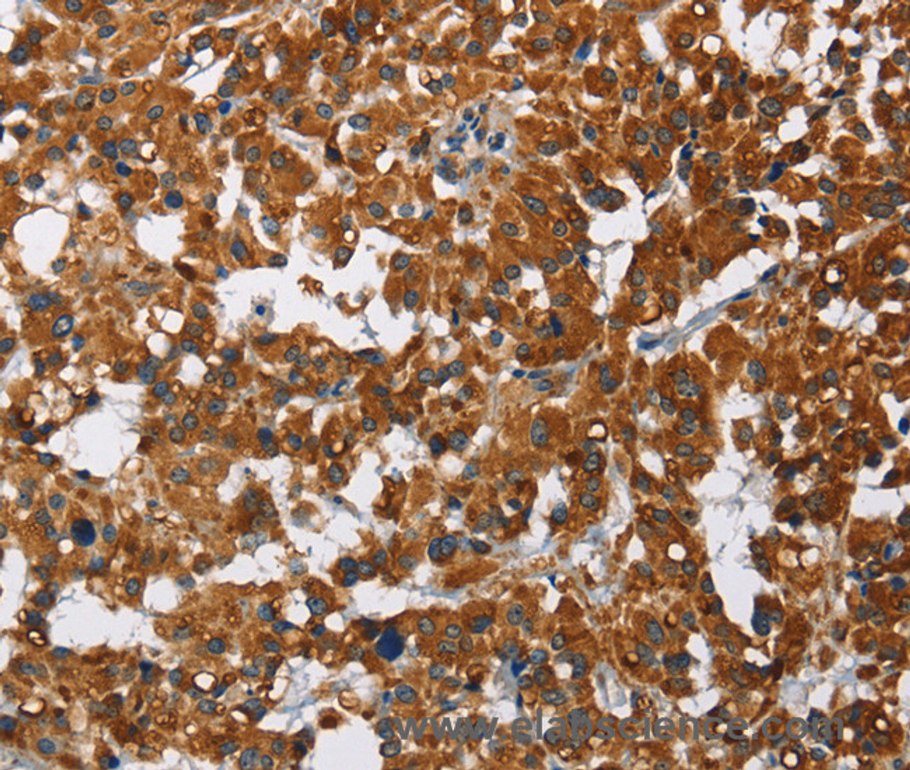 Immunohistochemistry of paraffin-embedded Human thyroid cancer using CAT Polyclonal Antibody at dilution of 1:40