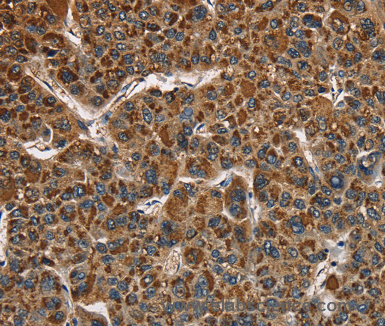 Immunohistochemistry of paraffin-embedded Human liver cancer using CAT Polyclonal Antibody at dilution of 1:40