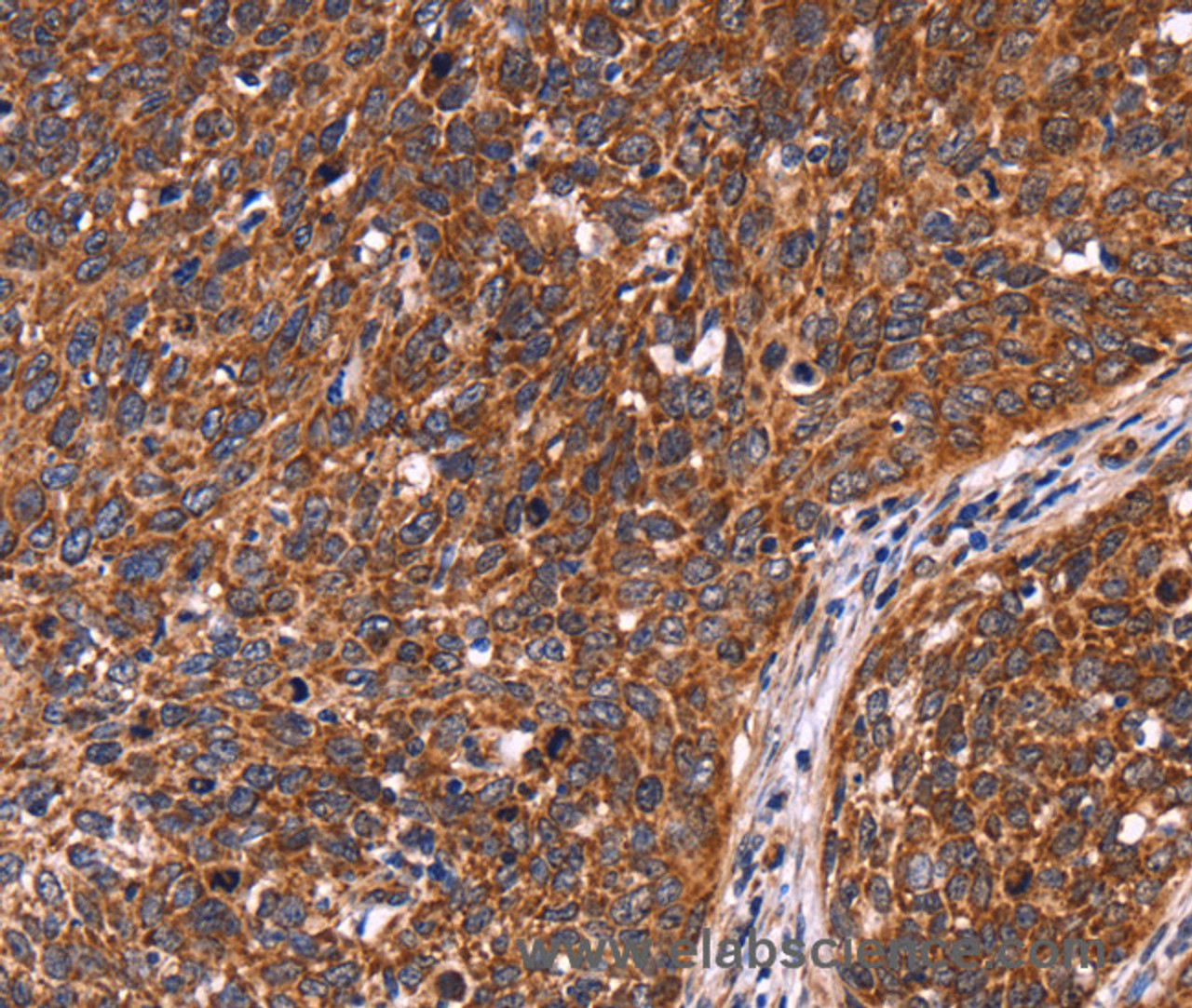 Immunohistochemistry of paraffin-embedded Human cervical cancer tissue using CCDC106 Polyclonal Antibody at dilution 1:60