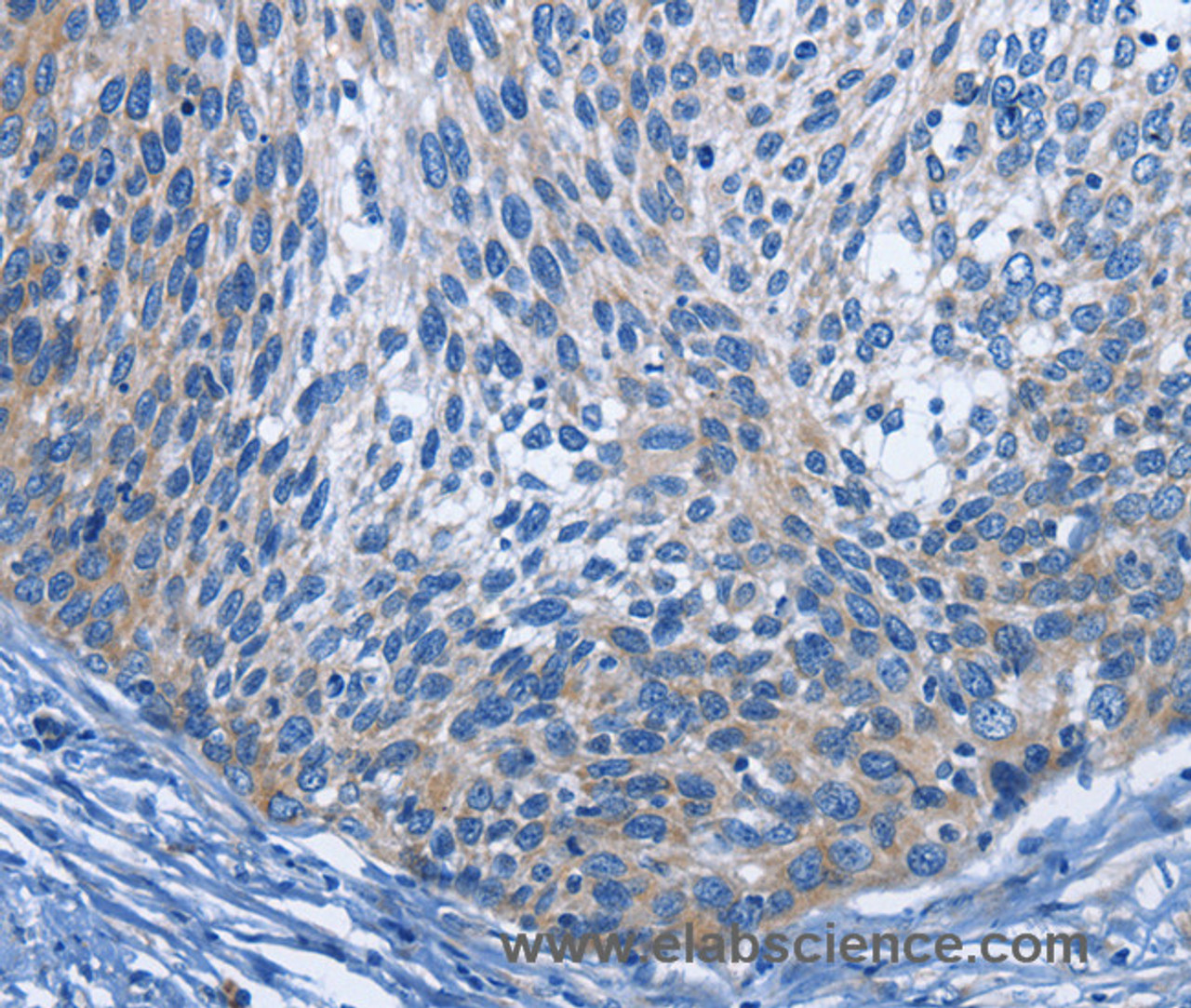 Immunohistochemistry of paraffin-embedded Human cervical cancer using IL2RB Polyclonal Antibody at dilution of 1:30