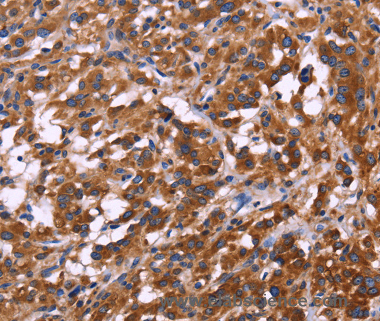 Immunohistochemistry of paraffin-embedded Human thyroid cancer tissue using KIR2DL1/3/4/S4 Polyclonal Antibody at dilution 1:30