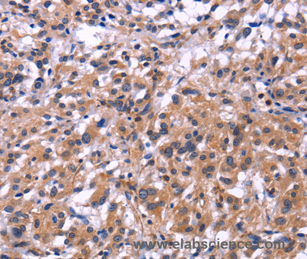 Immunohistochemistry of paraffin-embedded Human thyroid cancer tissue using SIGLEC5 Polyclonal Antibody at dilution 1:30
