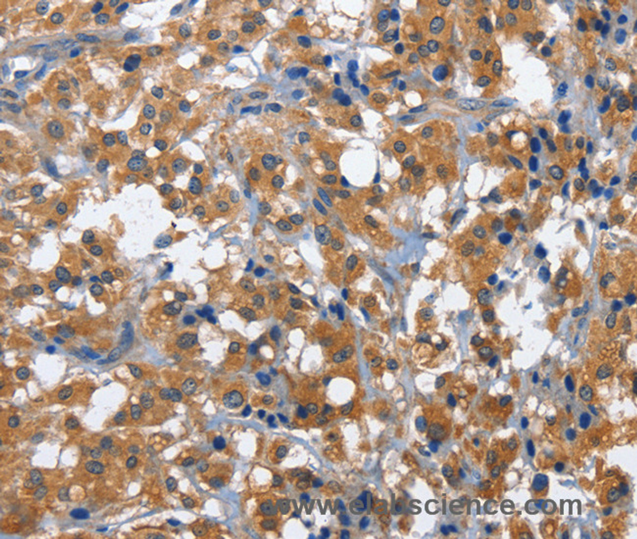 Immunohistochemistry of paraffin-embedded Human thyroid cancer using CD27 Polyclonal Antibody at dilution of 1:60