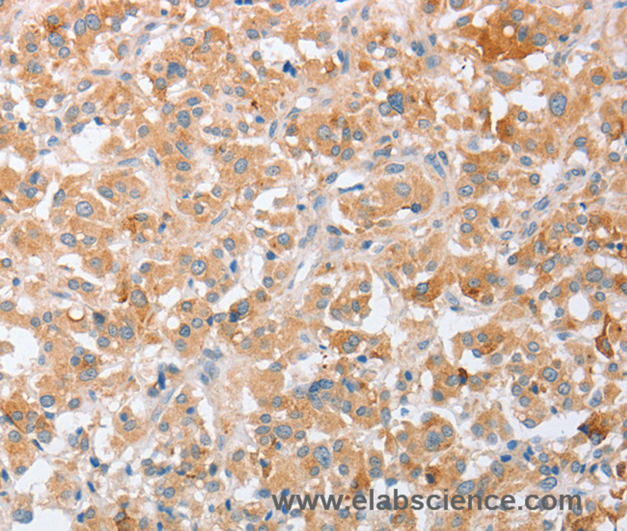 Immunohistochemistry of paraffin-embedded Human thyroid cancer tissue using SIGLEC9 Polyclonal Antibody at dilution 1:40