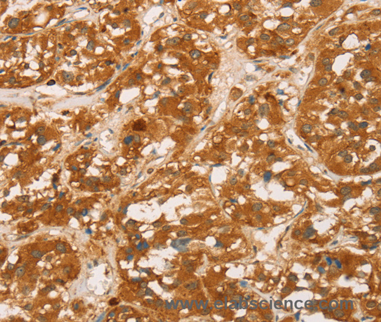 Immunohistochemistry of paraffin-embedded Human thyroid cancer tissue using CD43 Polyclonal Antibody at dilution 1:60