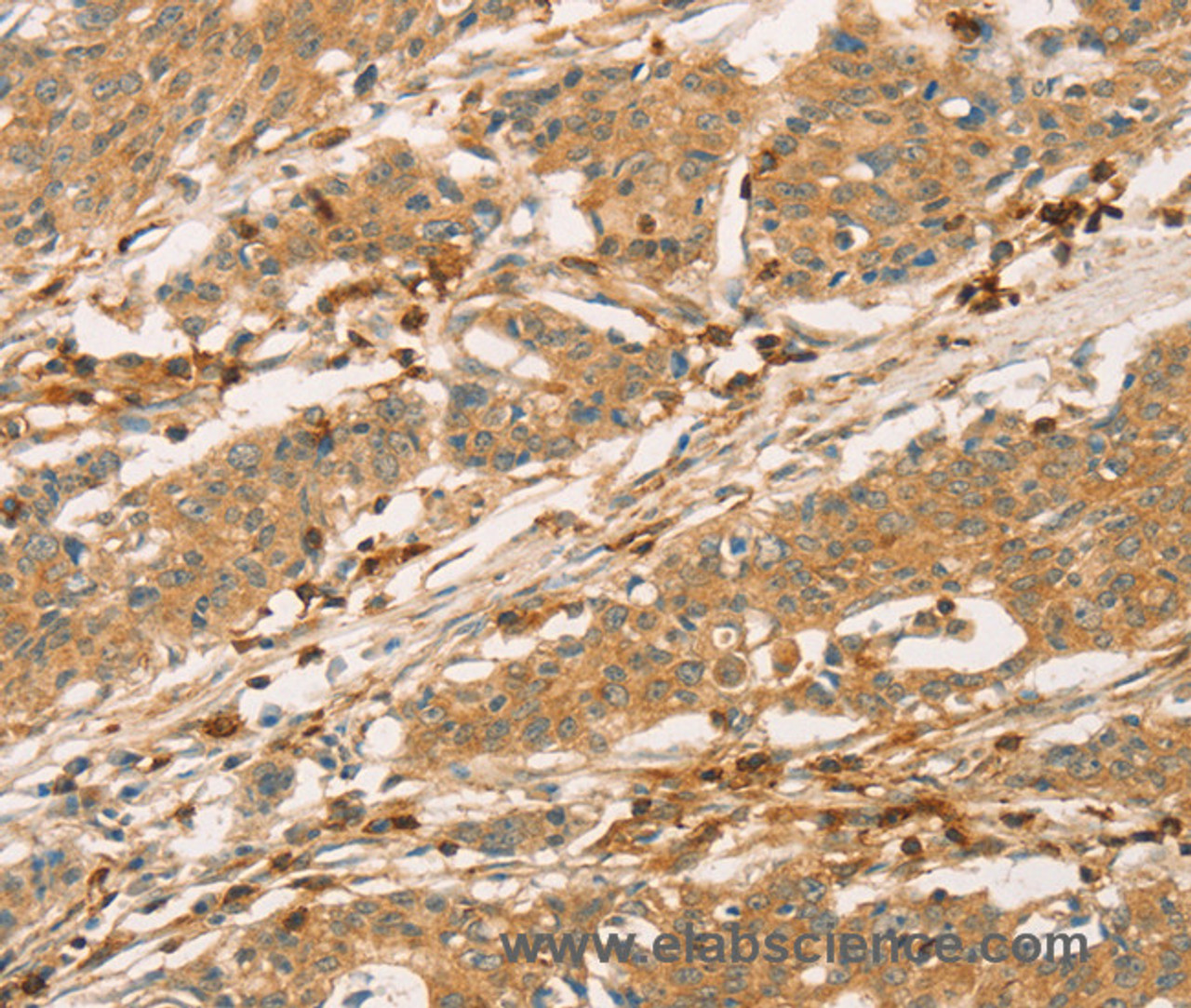 Immunohistochemistry of paraffin-embedded Human gastric cancer tissue using CD43 Polyclonal Antibody at dilution 1:60