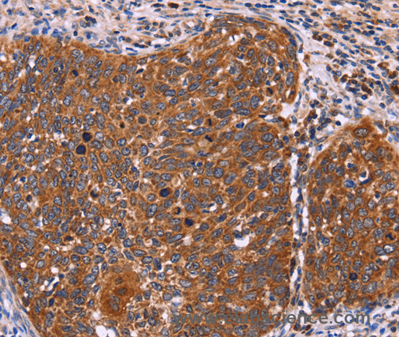 Immunohistochemistry of paraffin-embedded Human cervical cancer tissue using FBXW7 Polyclonal Antibody at dilution 1:40