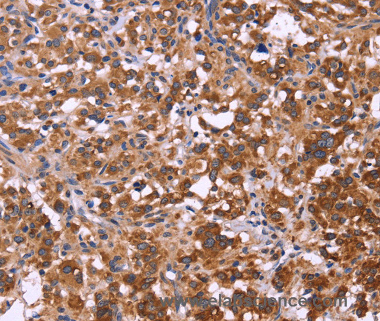 Immunohistochemistry of paraffin-embedded Human thyroid cancer tissue using FBXW7 Polyclonal Antibody at dilution 1:40