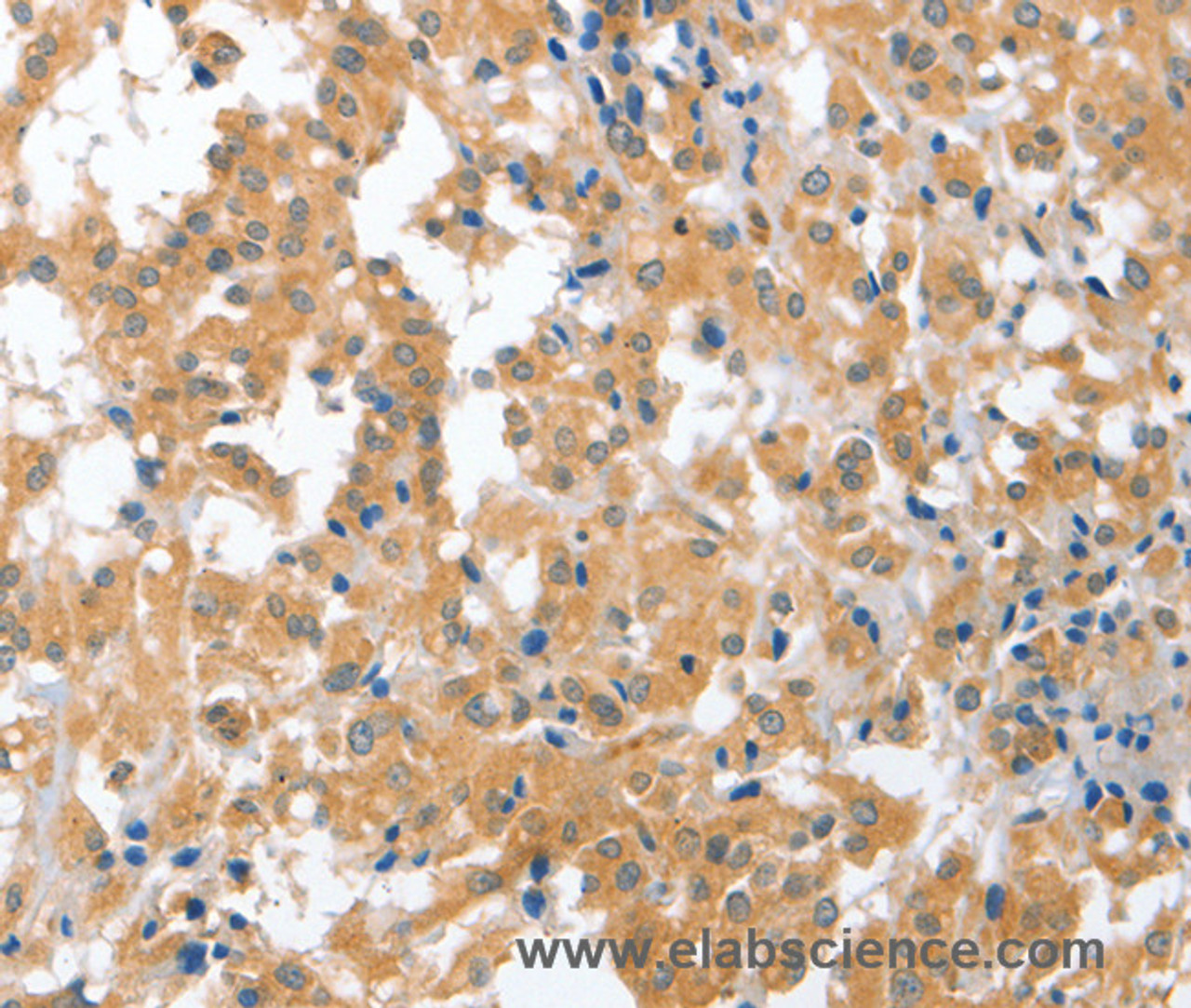 Immunohistochemistry of paraffin-embedded Human thyroid cancer tissue using CDR2 Polyclonal Antibody at dilution 1:60