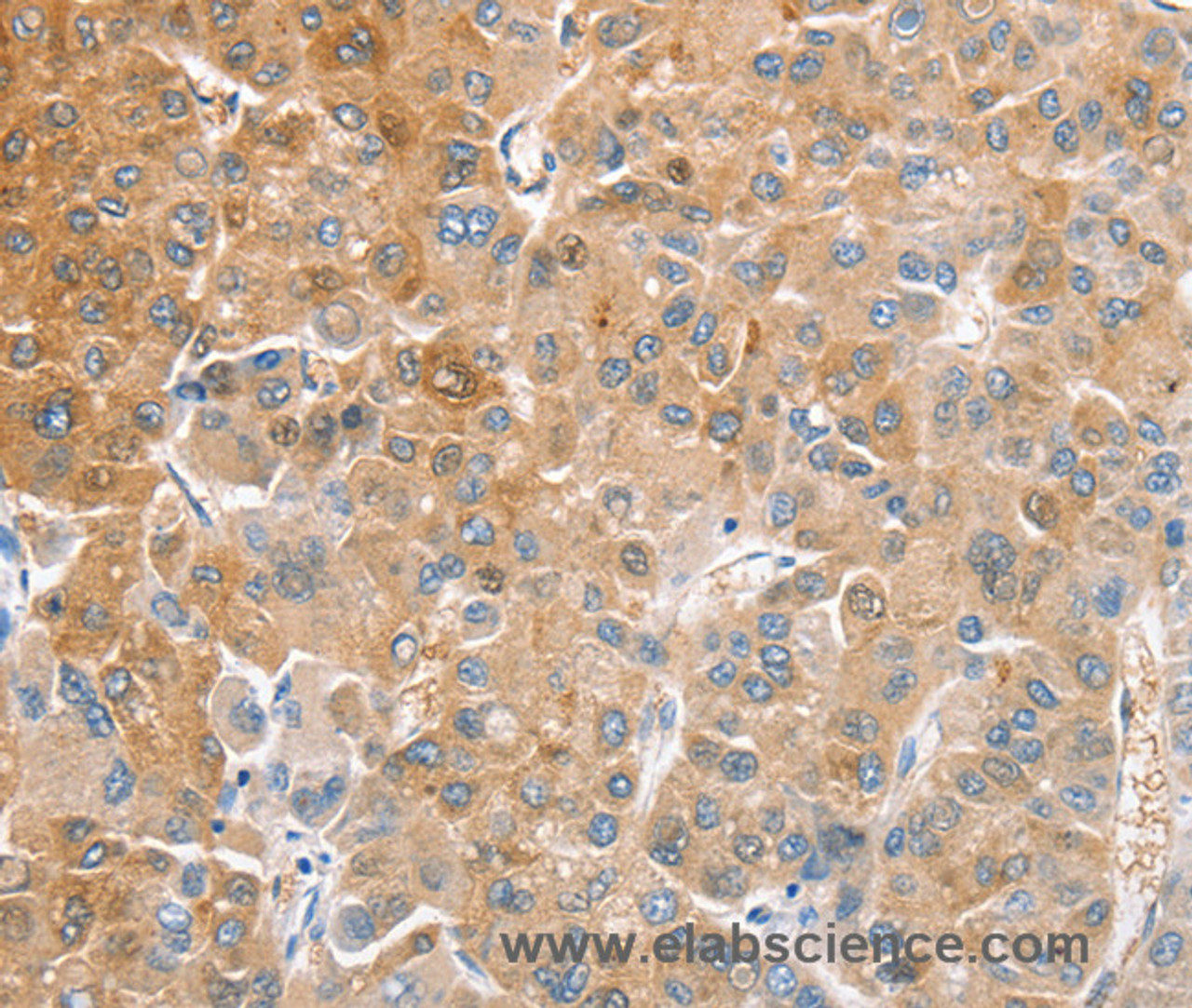 Immunohistochemistry of paraffin-embedded Human liver cancer tissue using CDR2 Polyclonal Antibody at dilution 1:60