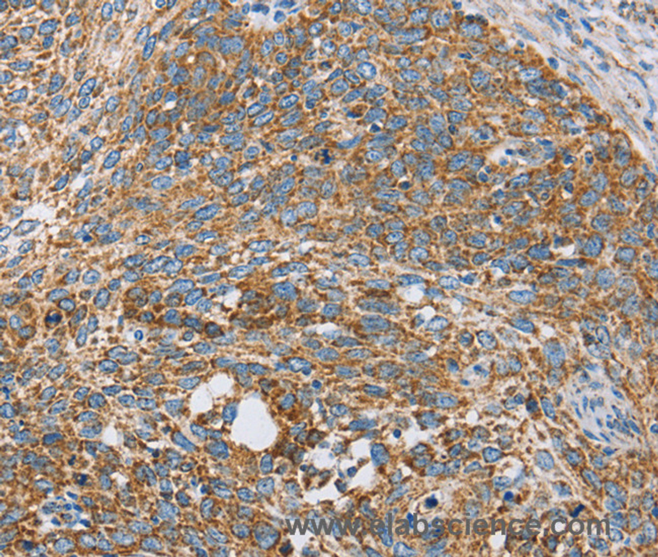 Immunohistochemistry of paraffin-embedded Human cervical cancer tissue using CENPO Polyclonal Antibody at dilution 1:40