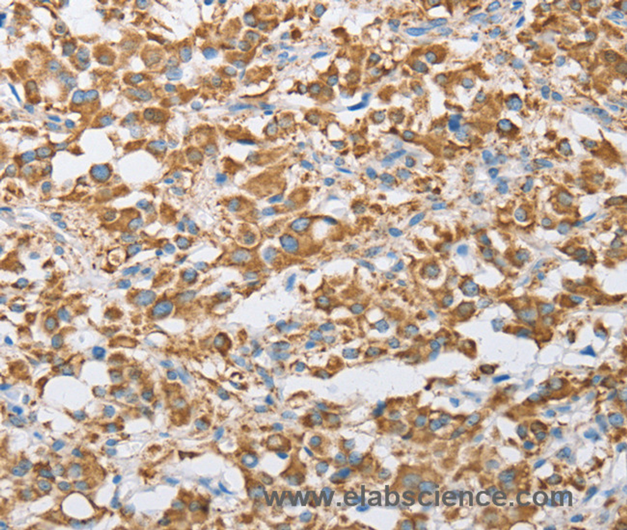 Immunohistochemistry of paraffin-embedded Human thyroid cancer tissue using CENPO Polyclonal Antibody at dilution 1:40